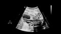 Ultrasound screen with fetal echocardiography