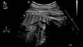 Ultrasound examination of the fetal heart