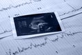 Fetus and electrocardiogram test Royalty Free Stock Photo
