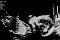 Fetus ultrasound at 20 weeks Royalty Free Stock Photo