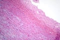 Fibrinoid necrosis in a vessel wall, light micrograph Royalty Free Stock Photo