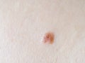 Fibroma on human skin, close up