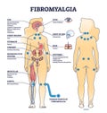 Fibromyalgia as musculoskeletal pain disorder tender points outline diagram Royalty Free Stock Photo