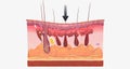 With fibromyalgia, nerves become hypersensitive to external stimuli, a change known as central sensitization