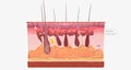 With fibromyalgia, nerves become hypersensitive to external stimuli, a change known as central sensitization