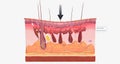 With fibromyalgia, nerves become hypersensitive to external stimuli, a change known as central sensitization