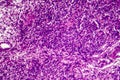 Fibrosarcoma, malignant tumor of fibroblasts