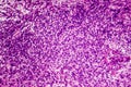 Fibrosarcoma, malignant tumor of fibroblasts Royalty Free Stock Photo
