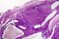 Fibrosarcoma, malignant tumor of fibroblasts Royalty Free Stock Photo