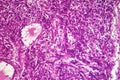 Fibrosarcoma, malignant tumor of fibroblasts