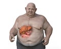 Fibrotic liver in obese man, 3D illustration. Concept of obesity and inner organs diseases