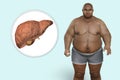 Fibrotic liver in obese man, 3D illustration. Concept of obesity and inner organs diseases