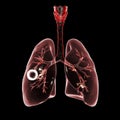 Fibrous-cavernous pulmonary tuberculosis Royalty Free Stock Photo