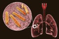 Fibrous-cavernous pulmonary tuberculosis Royalty Free Stock Photo