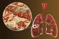 Fibrous-cavernous pulmonary tuberculosis Royalty Free Stock Photo