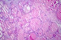 Fibrous thyroiditis, light micrograph