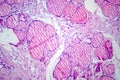 Fibrous thyroiditis, light micrograph