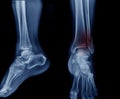 Fibular bone fracture