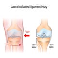 Fibular collateral ligament injury. joint anatomy Royalty Free Stock Photo