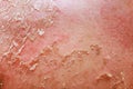 In field of dermatology, psoriatic eczema presents unique challenges for diagnosis a treatment.
