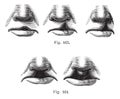Fig. 163. Degrees of cleft lip simple, Fig. 164. Cleft lip double, vintage engraving