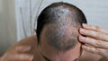 Fight against hair loss in men. Shots to the head. Treatment of male pattern baldness. Early hair loss. A man uses a