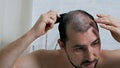 Fight against hair loss in men. Shots to the head. Treatment of male pattern baldness. Early hair loss. A man uses a