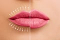 Fillers. Lip augmentation. Beautiful pink lips Royalty Free Stock Photo