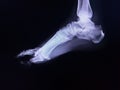 Film Ankle joint Clost up fracture right Calcaneus.Soft tissu swelling Medical image concept.