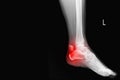 Film ankle X-ray radiograph showing heel bone broken close fracture calcaneus . Medical technology and healthcare concept