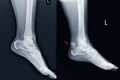 Film ankle X-ray radiograph showing heel bone narmal and broken on red point close fracture calcaneus . Medical technology and