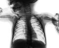 Film chest x-ray of child . isolated background Royalty Free Stock Photo