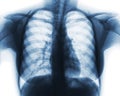 Film chest x-ray of normal woman chest