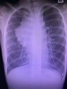 Film chest x ray show anterior mediastinal mss