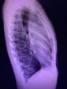Film chest x ray show anterior mediastinal mss