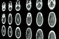 film CT scan of brain show ischemic stroke and hemorrhagic stroke Royalty Free Stock Photo