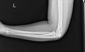 Film elbow AP a male 25 year old showed fracture