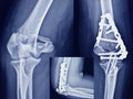 Film Elbow fracture distal humerus bone
