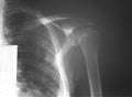 Film left shoulder of a 52 years old man with multiple myeloma (MM), demonstrated punch out bone lesions of humerus and scapular