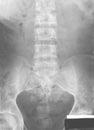 Film lumbo-sacral (LS) spines of an adult elderly man, antero-posterior (AP) view, demonstrated coarse trabeculation of lumbar