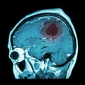 Film MRI of brain with brain tumor ( Sagittal plane , side view , lateral view ) ( Medical , Health care , Science Background ) Royalty Free Stock Photo