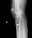 Film operative process of right knee lateral view