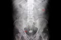 Film of a patient with kidney and urinary bladder stones