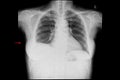 Film of a patient with pleural effusion