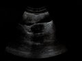 Film Ultrasound, ovarian cysts,Internal organs examination for women