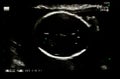 Film Ultrasound of the skull and baby`s brain in the womb of mother. Health care and antenatal care, top view