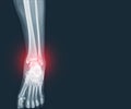 Film x-ray Ankle and Foot fracture distal fibula bone with soft tissues swelling on red mark.Medical healthcare concept Royalty Free Stock Photo