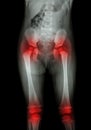 Film x-ray body of child (abdomen,buttock,thigh,knee) and arthritis at both hip , both knee (Gout,Rheumatoid) Royalty Free Stock Photo