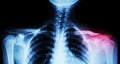 Film x-ray both clavicle AP ( front view ) : show fracture distal left clavicle Royalty Free Stock Photo