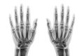 Film x-ray both hand AP show normal human hands on white background & x28; isolated & x29;